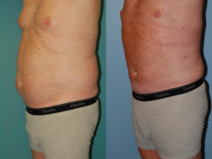 Before & After Liposuction Case 36 View #2 View in Ellicott City, MD