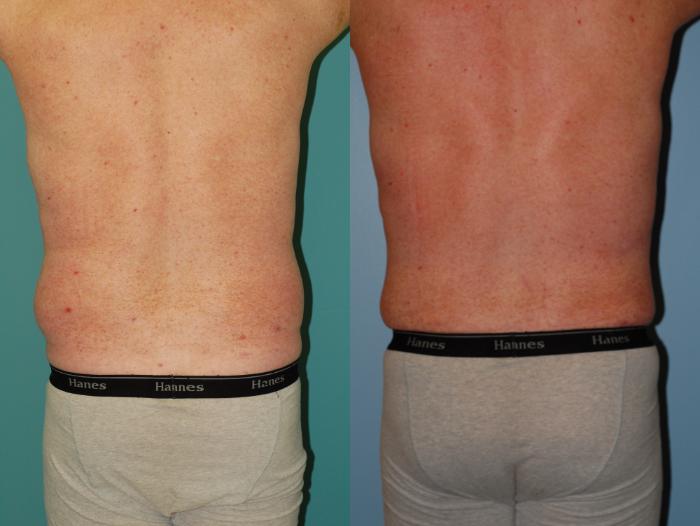 Before & After Liposuction Case 36 View #3 View in Ellicott City, MD