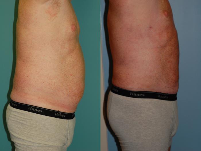 Before & After Liposuction Case 36 View #4 View in Ellicott City, MD