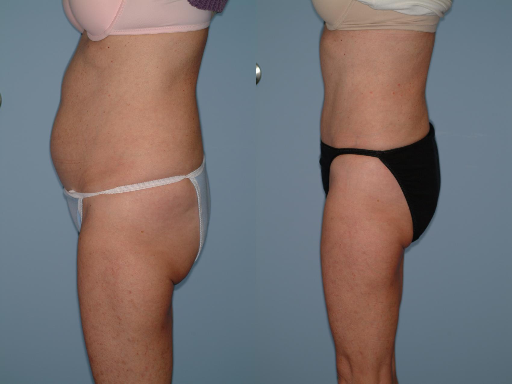 Before & After Liposuction Case 37 View #1 View in Ellicott City, MD