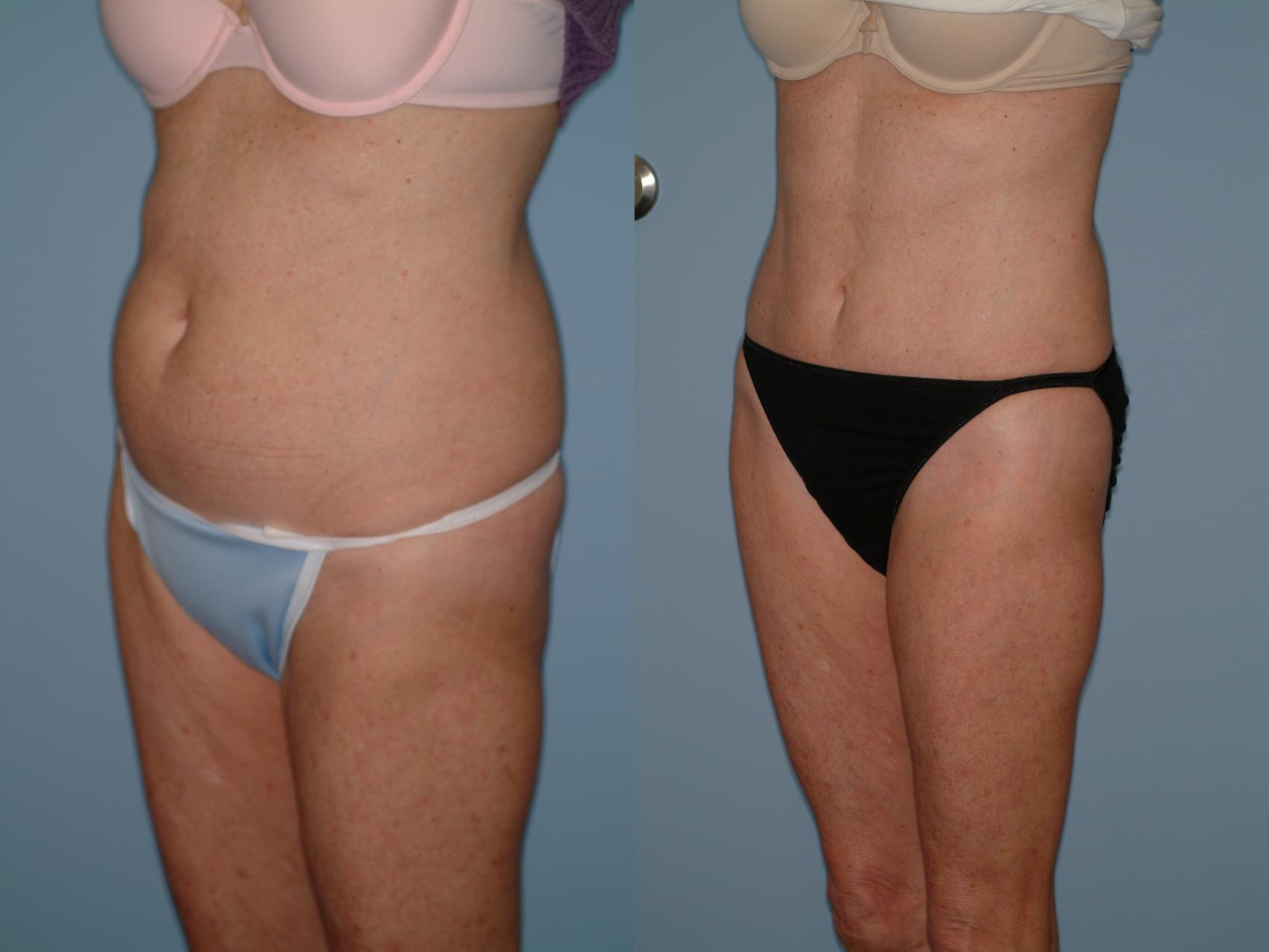Before & After Liposuction Case 37 View #2 View in Ellicott City, MD