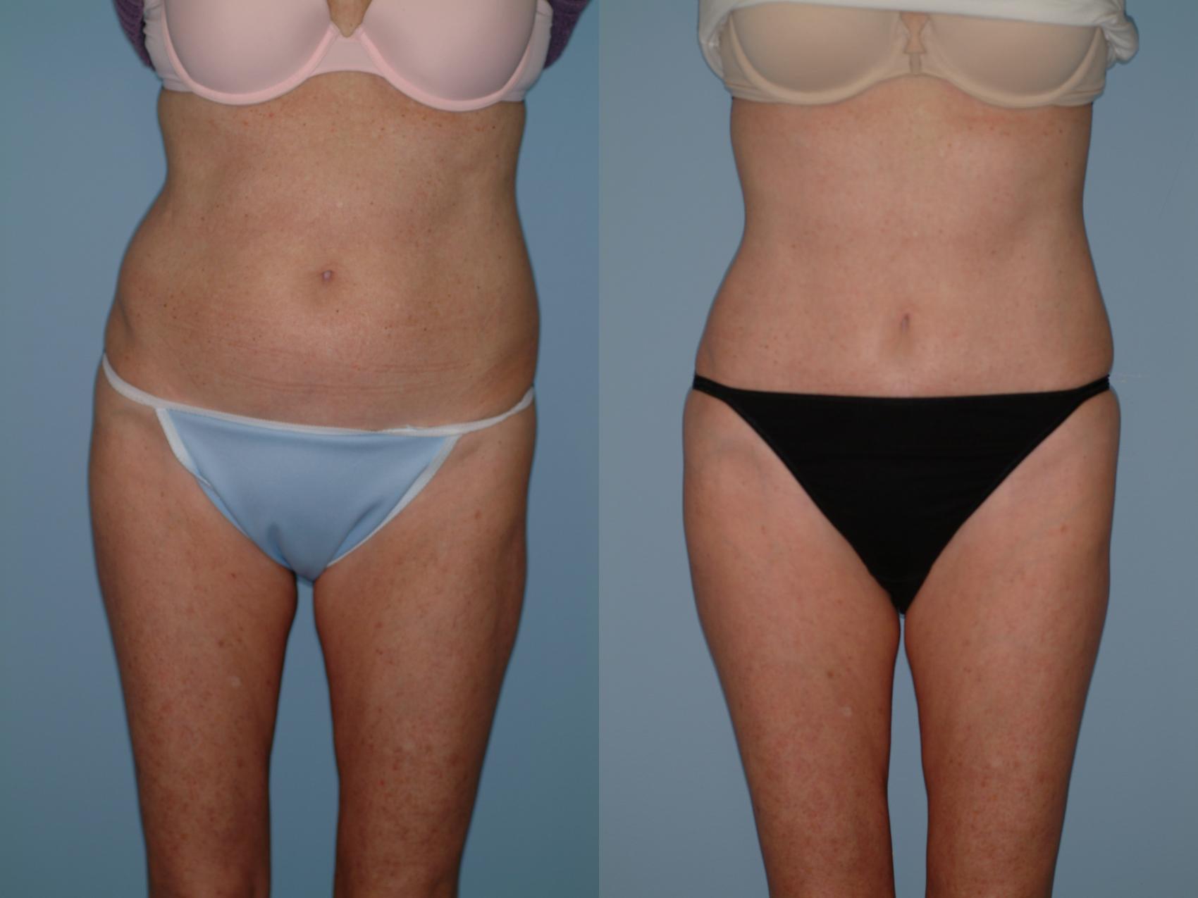 Before & After Liposuction Case 37 View #3 View in Ellicott City, MD