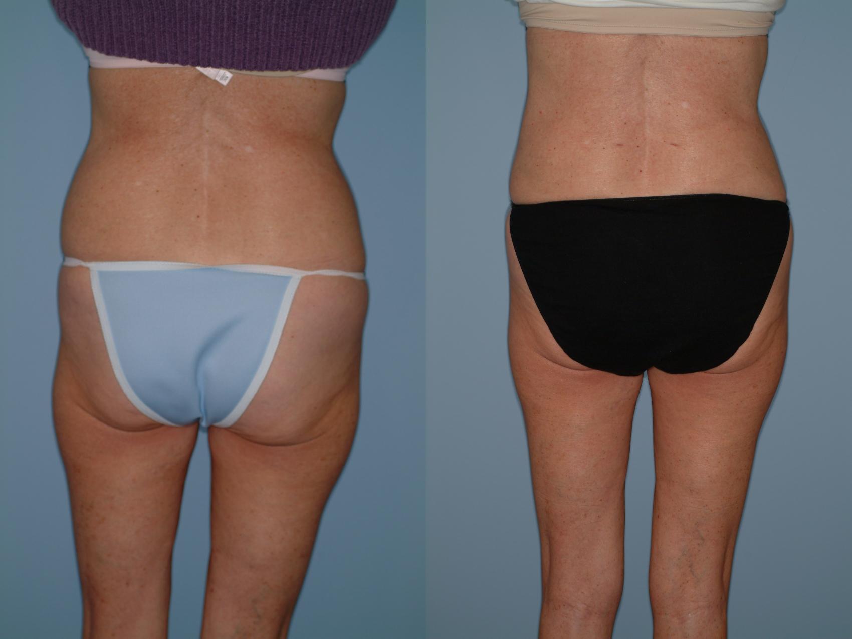 Before & After Liposuction Case 37 View #4 View in Ellicott City, MD