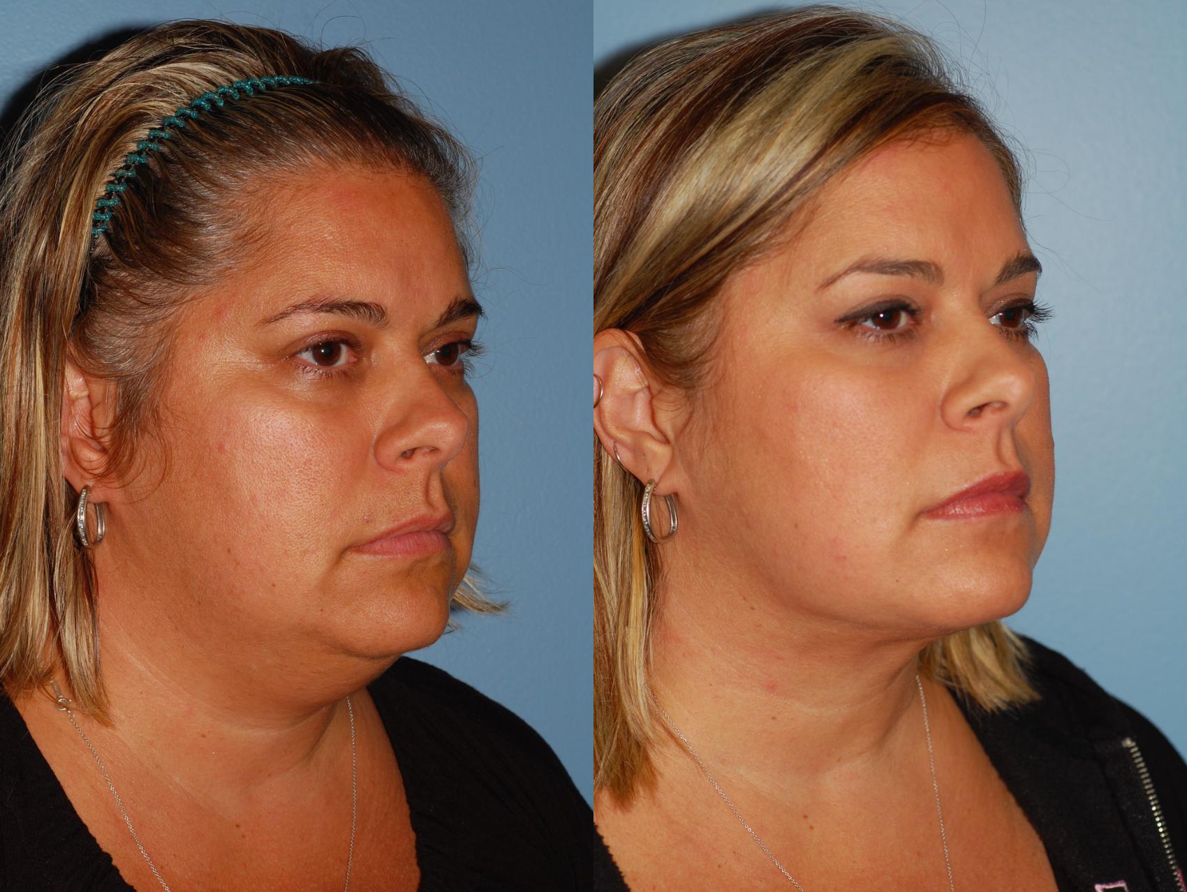 Before & After Liposuction Case 38 View #2 View in Ellicott City, MD