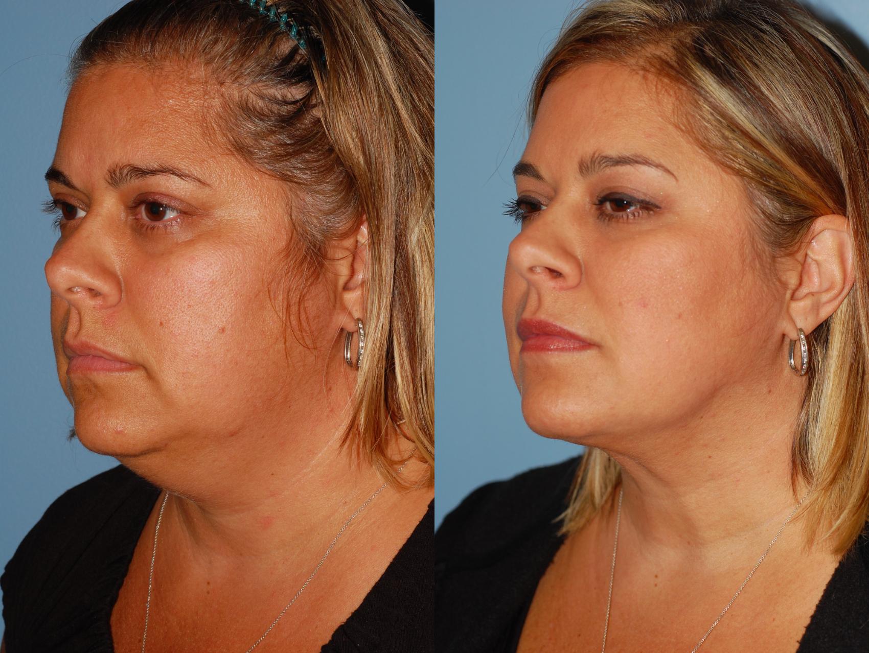 Before & After Liposuction Case 38 View #3 View in Ellicott City, MD