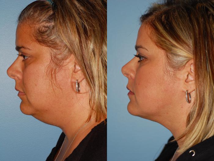 Before & After Liposuction Case 38 View #4 View in Ellicott City, MD