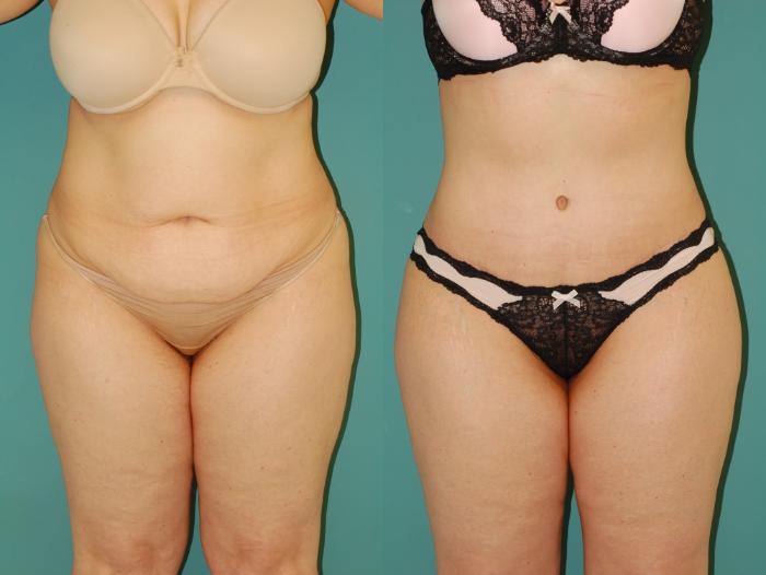 Tummy Tuck Before & After Photos of Patient at The Center for
