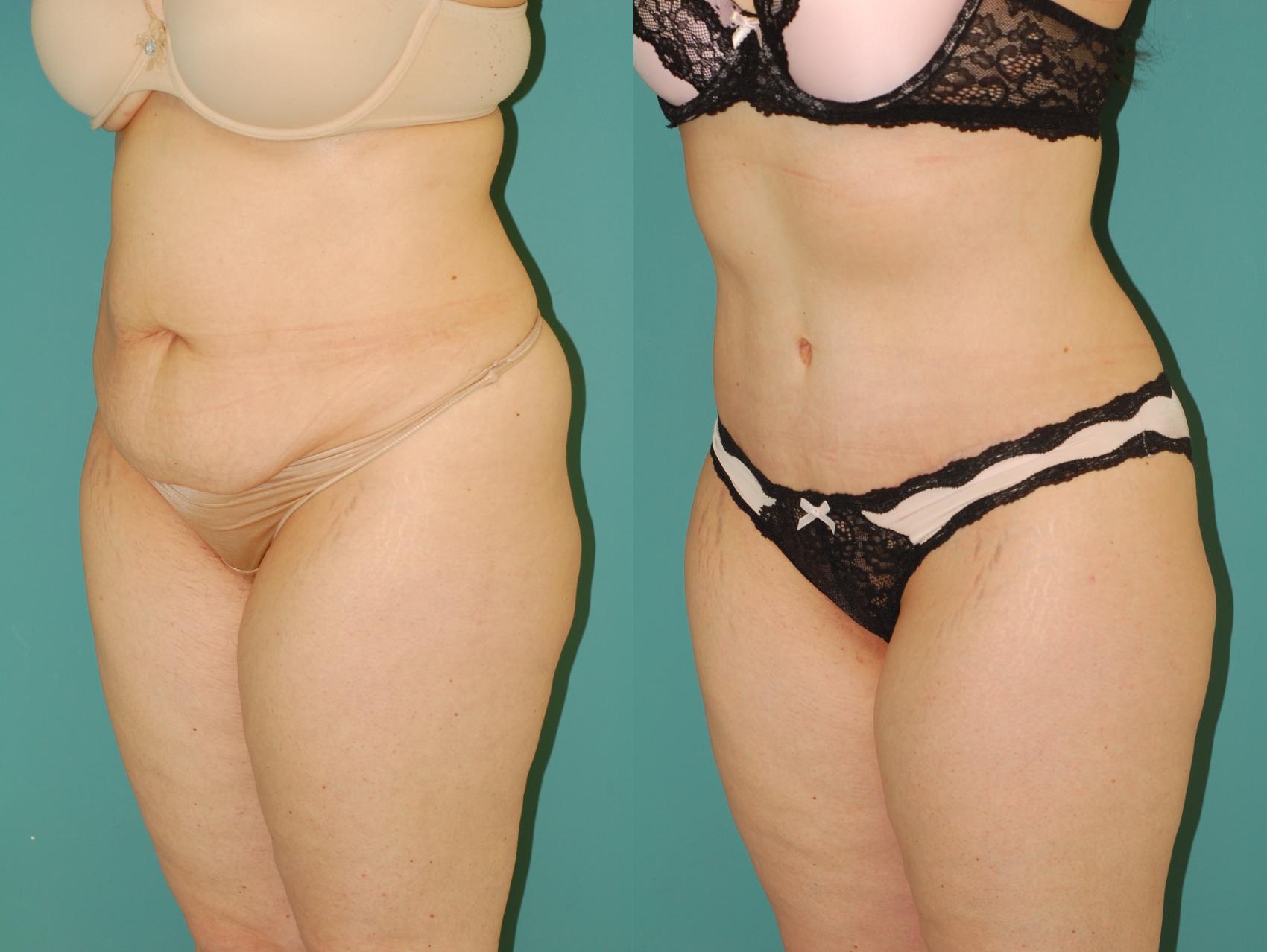 Before & After Liposuction Case 54 View #2 View in Ellicott City, MD