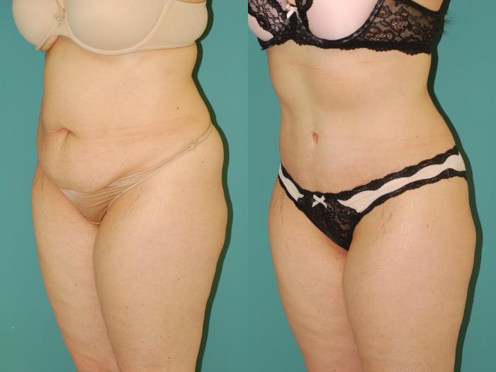 Before & After Tummy Tuck Case 54 View #2 View in Ellicott City, MD