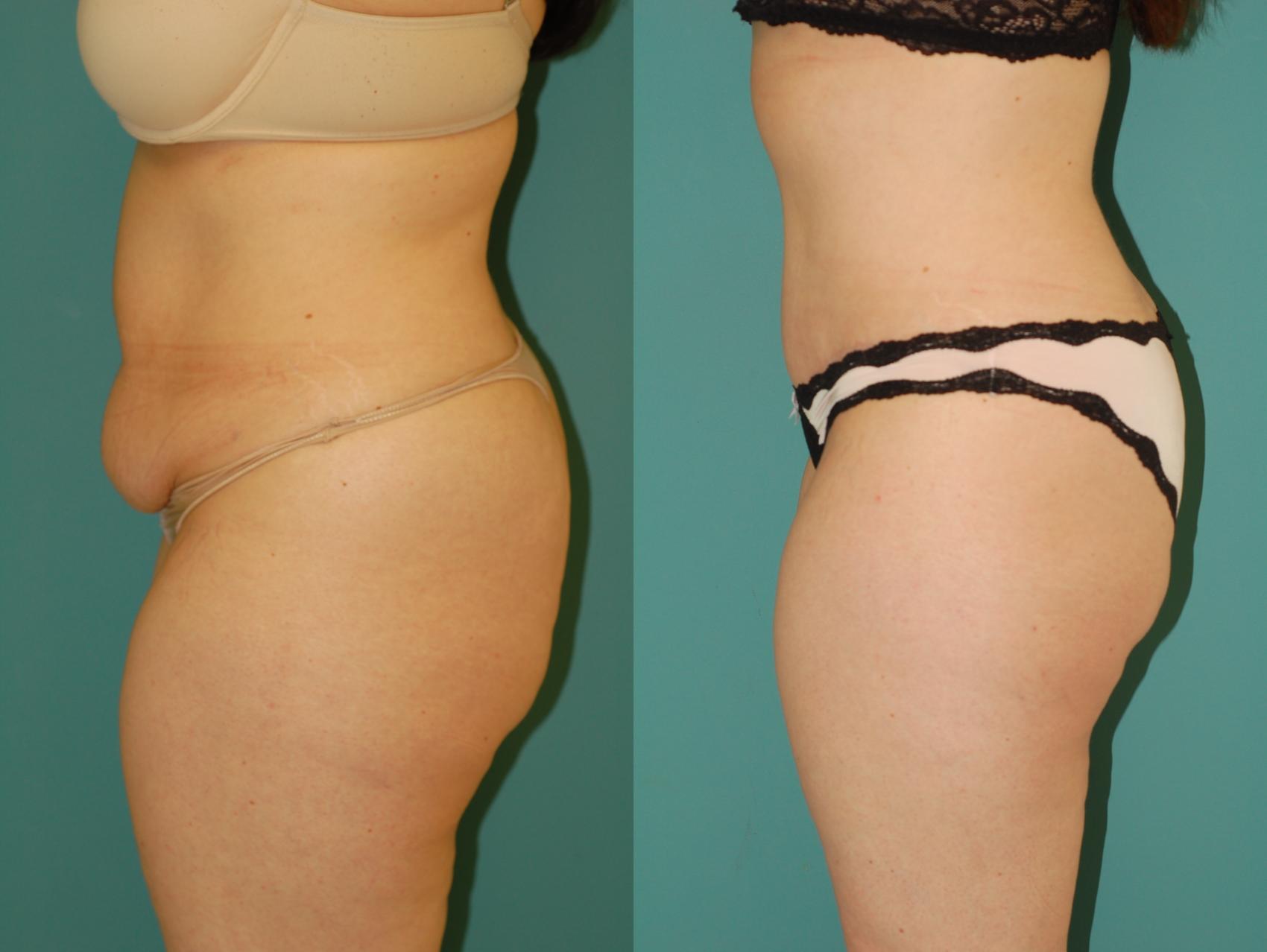 Before & After Liposuction Case 54 View #3 View in Ellicott City, MD