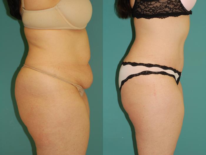 Before & After Liposuction Case 54 View #4 View in Ellicott City, MD