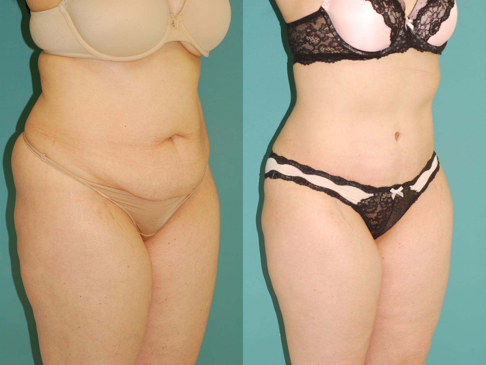 Before & After Liposuction Case 54 View #5 View in Ellicott City, MD