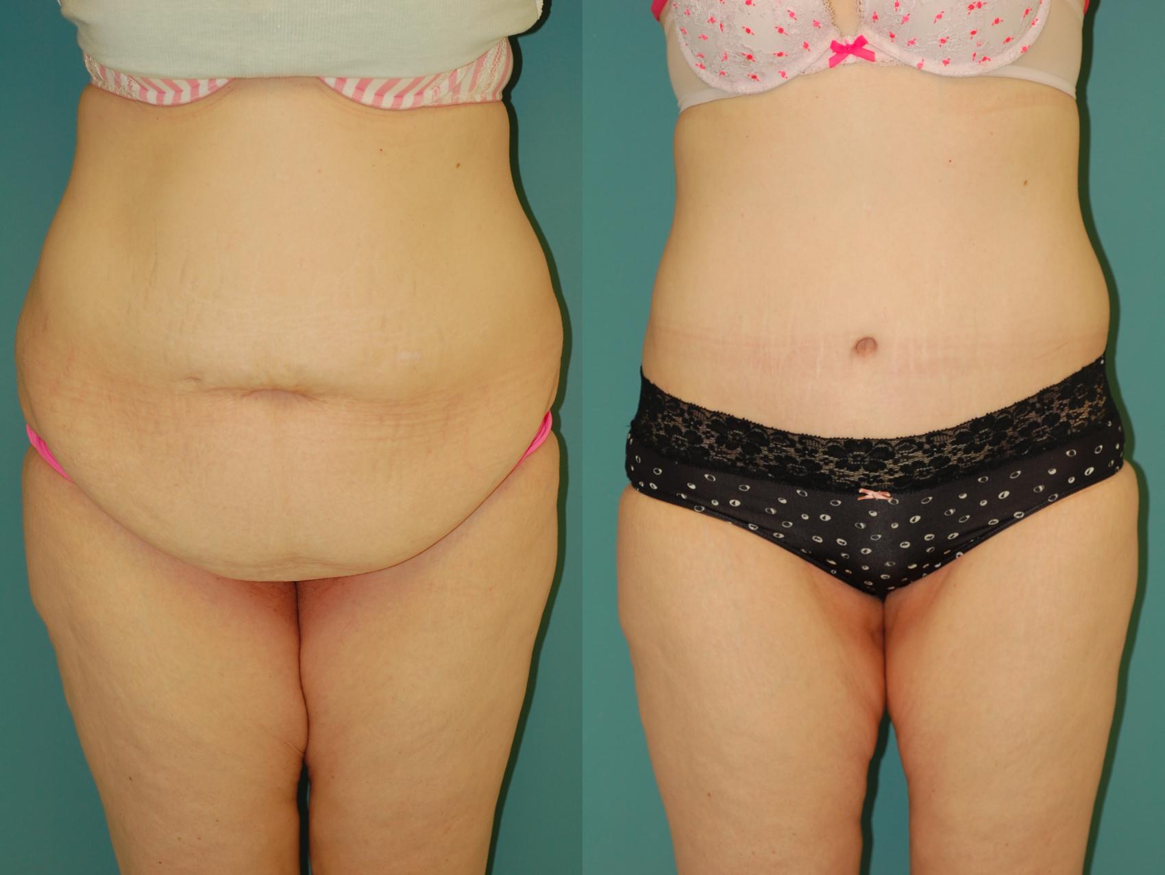 Before & After Tummy Tuck Case 55 View #1 View in Ellicott City, MD