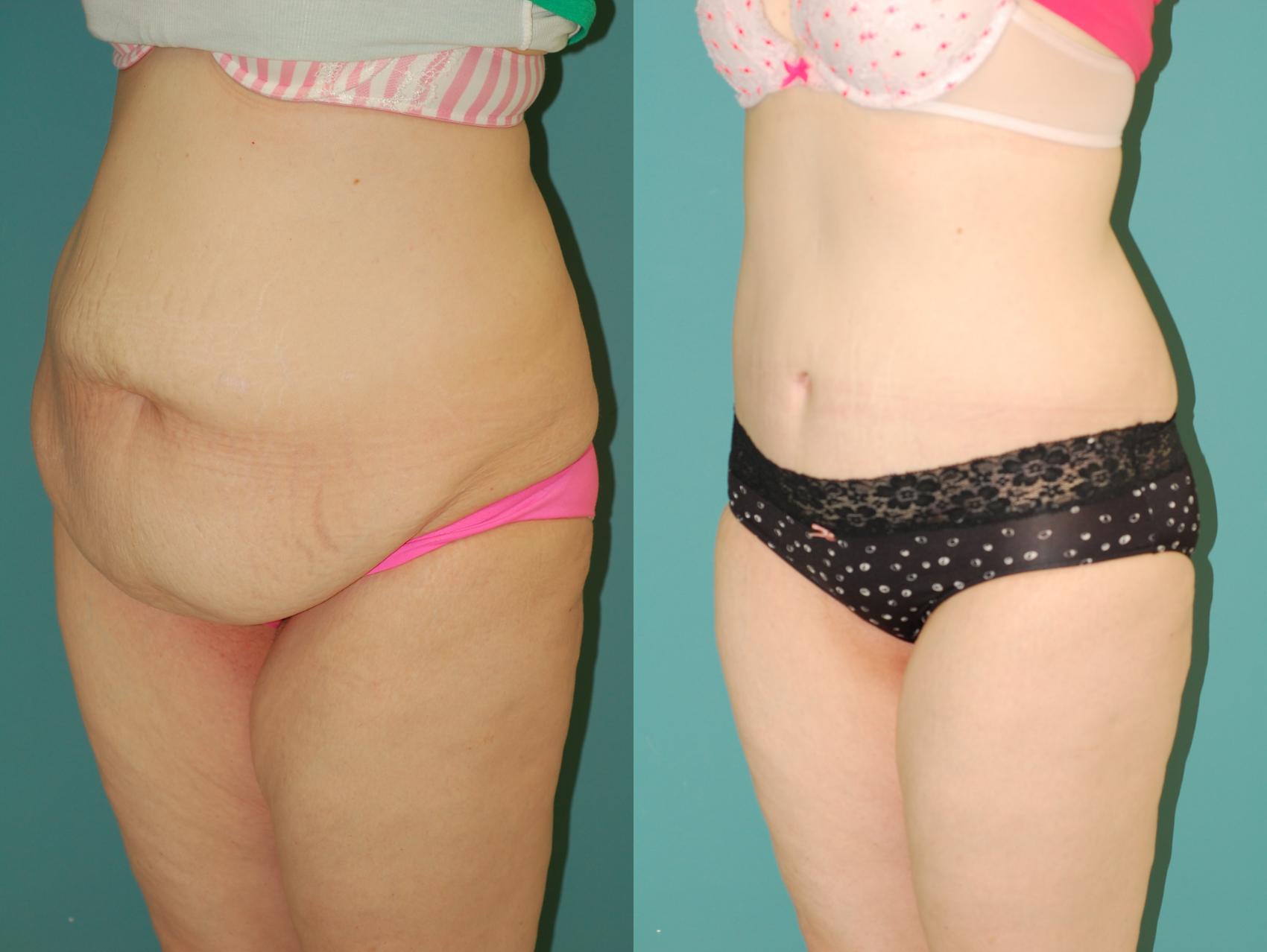 Before & After Liposuction Case 55 View #2 View in Ellicott City, MD