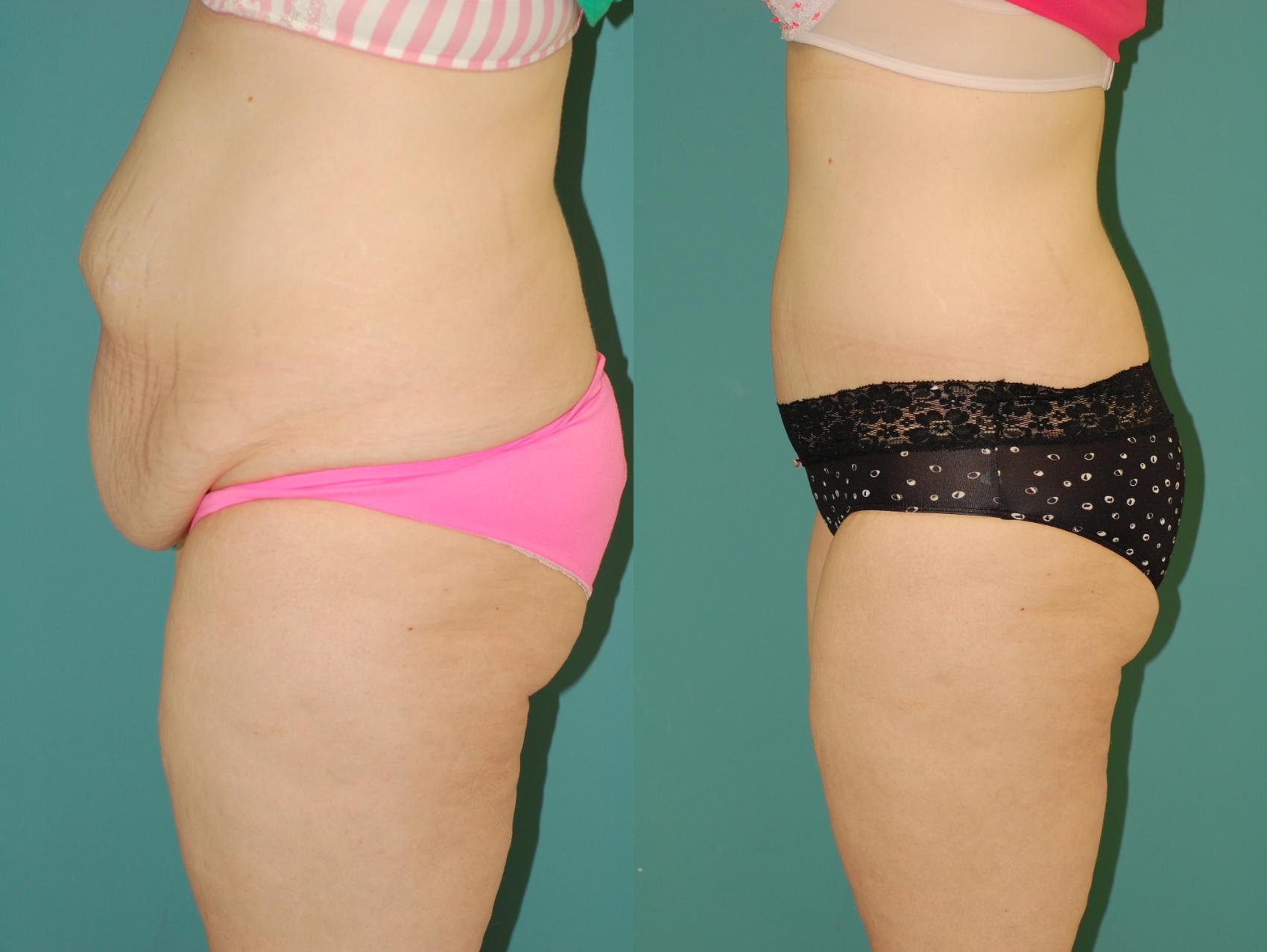 Before & After Liposuction Case 55 View #3 View in Ellicott City, MD
