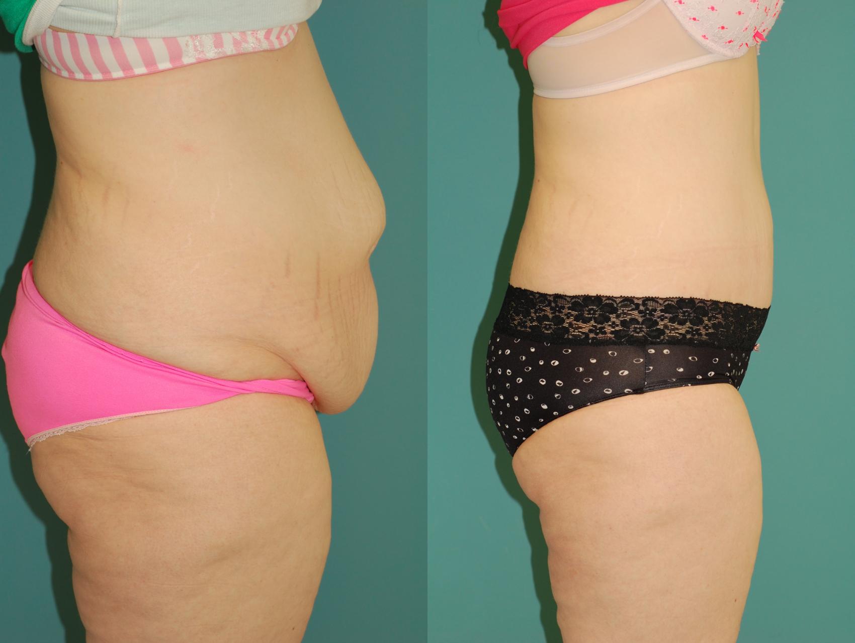 Before & After Liposuction Case 55 View #4 View in Ellicott City, MD