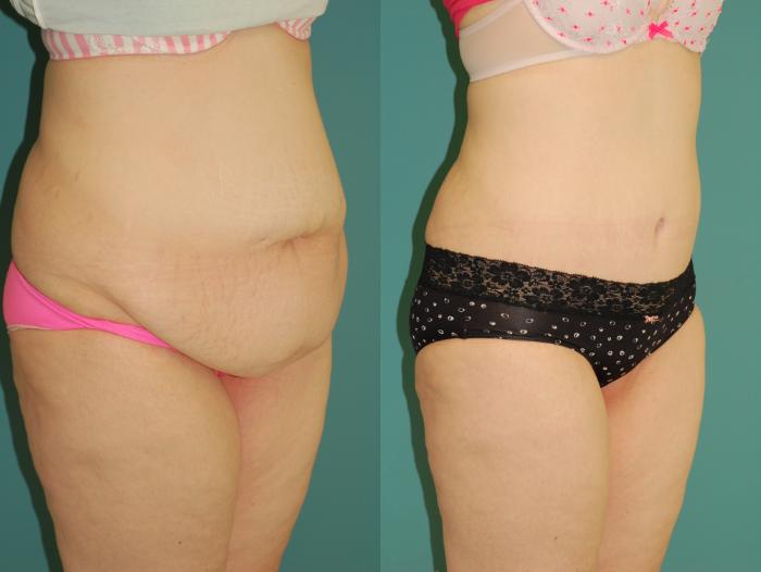 Before & After Liposuction Case 55 View #5 View in Ellicott City, MD