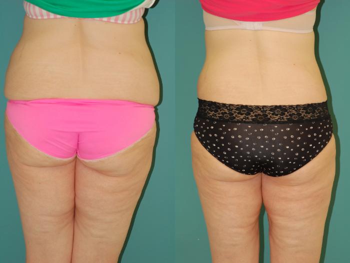 Before & After Liposuction Case 55 View #6 View in Ellicott City, MD