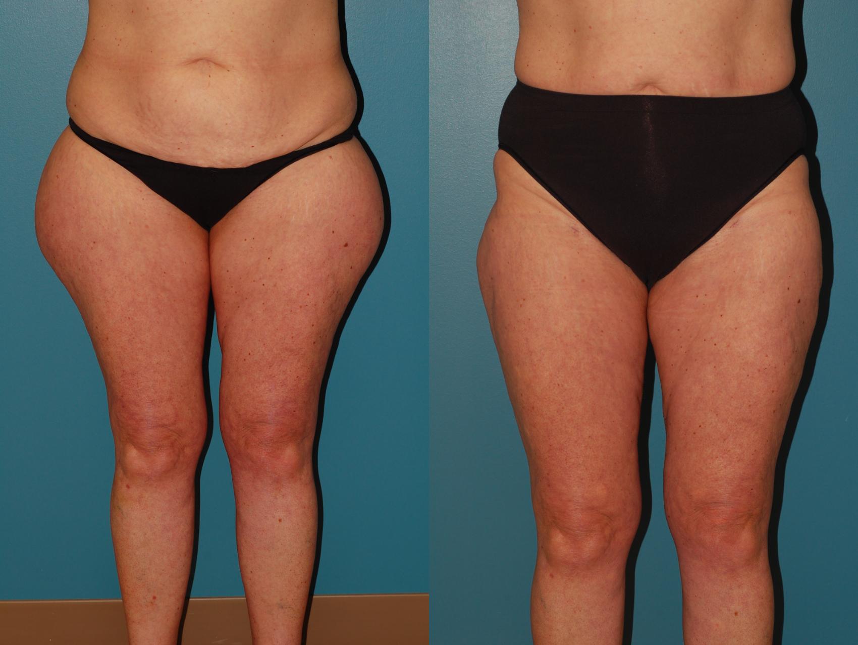 Before & After Liposuction Case 67 View #1 View in Ellicott City, MD