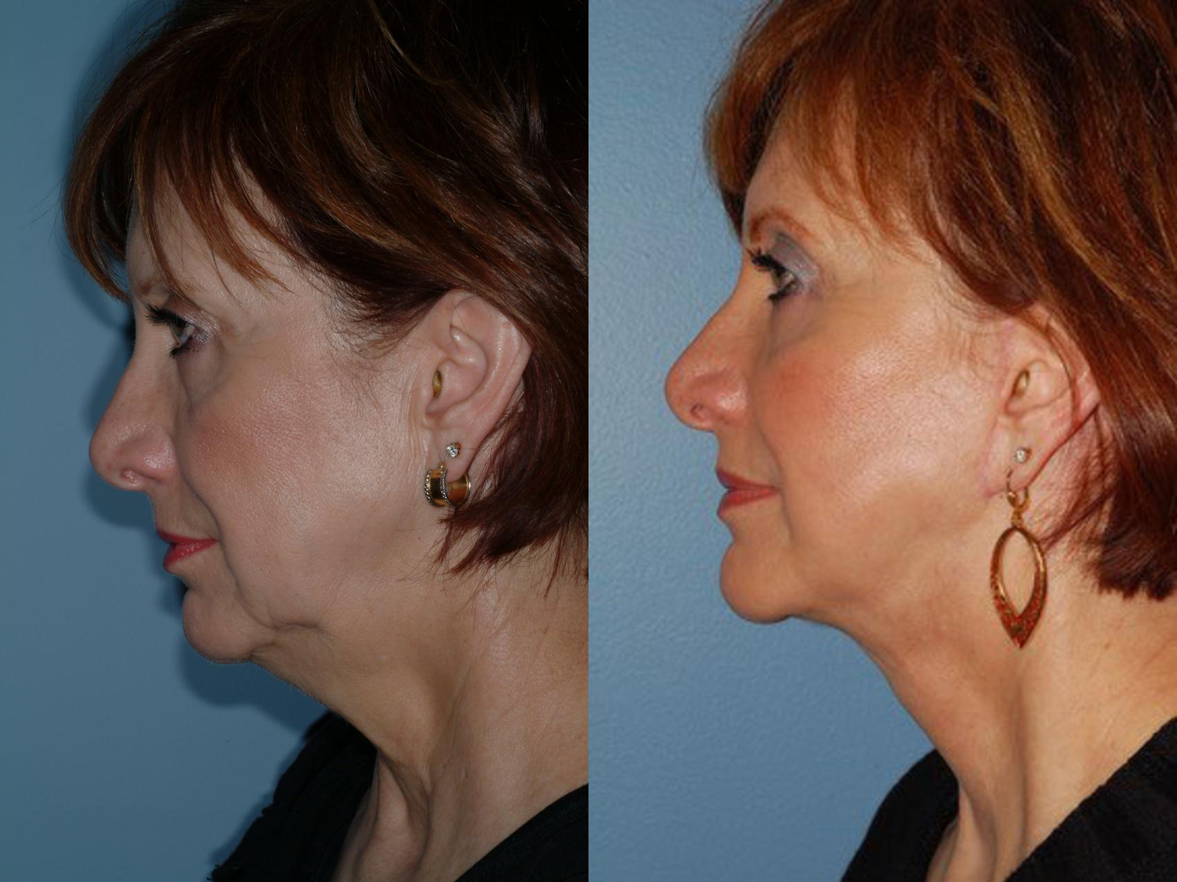 Before & After Upper Eyelid Surgery Case 6 View #1 View in Ellicott City, MD