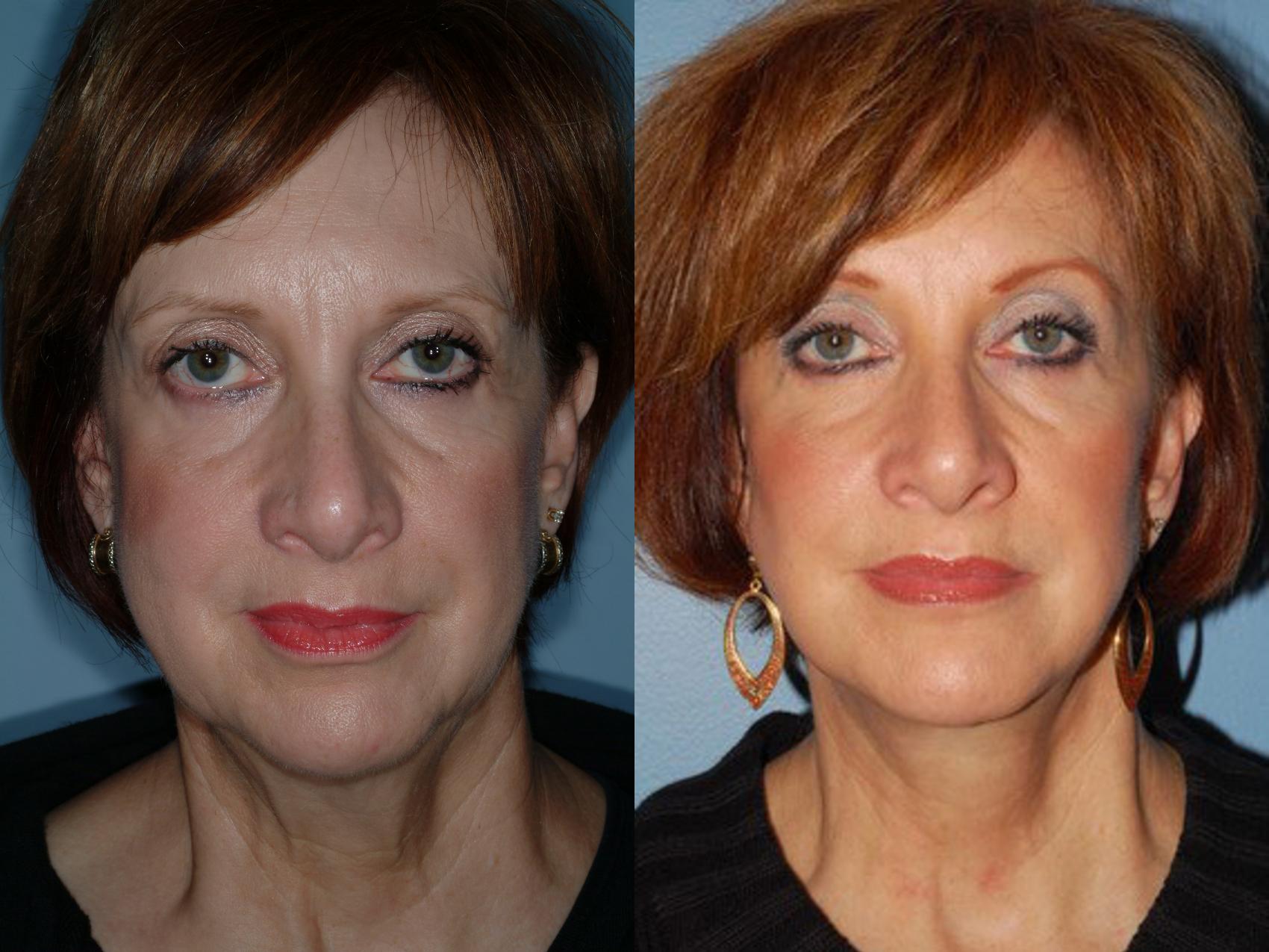 Before & After Lower Eyelid Surgery Case 6 View #2 View in Ellicott City, MD