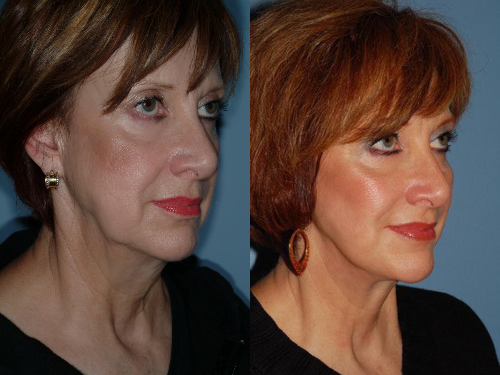 Before & After Lower Eyelid Surgery Case 6 View #3 View in Ellicott City, MD