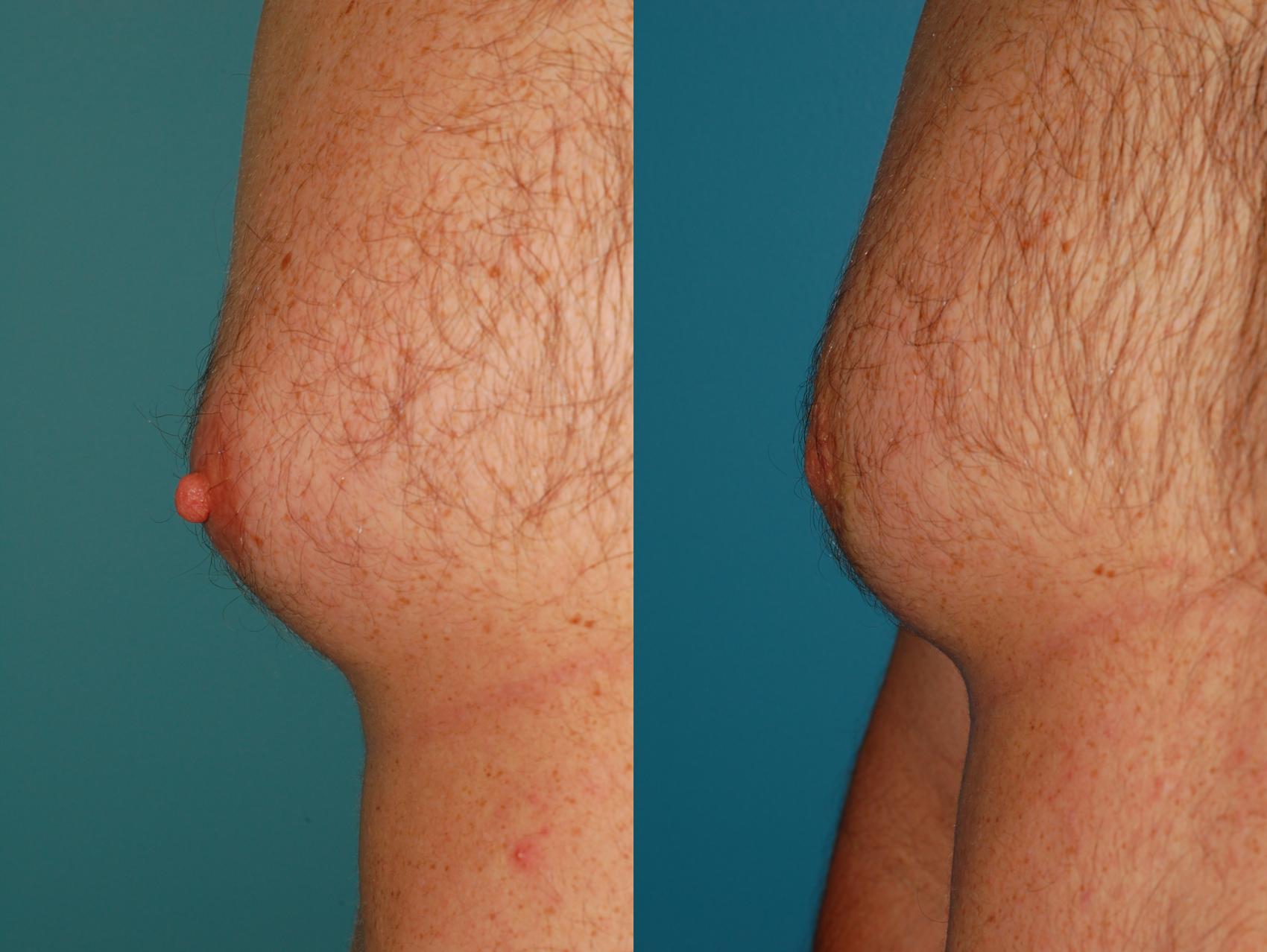 Before & After Nipple Reduction Case 48 View #1 View in Ellicott City, MD