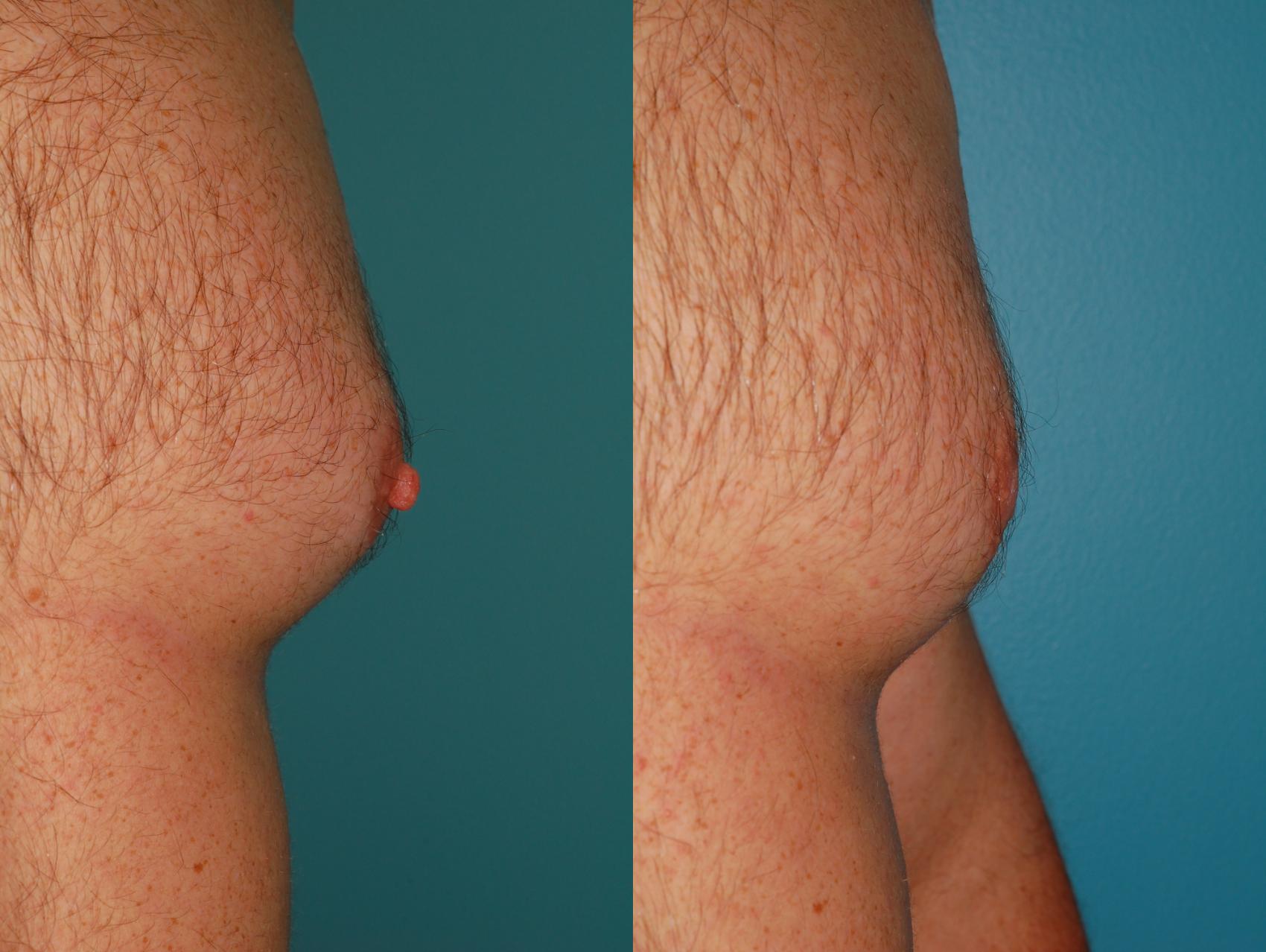 Before & After Nipple Reduction Case 48 View #2 View in Ellicott City, MD