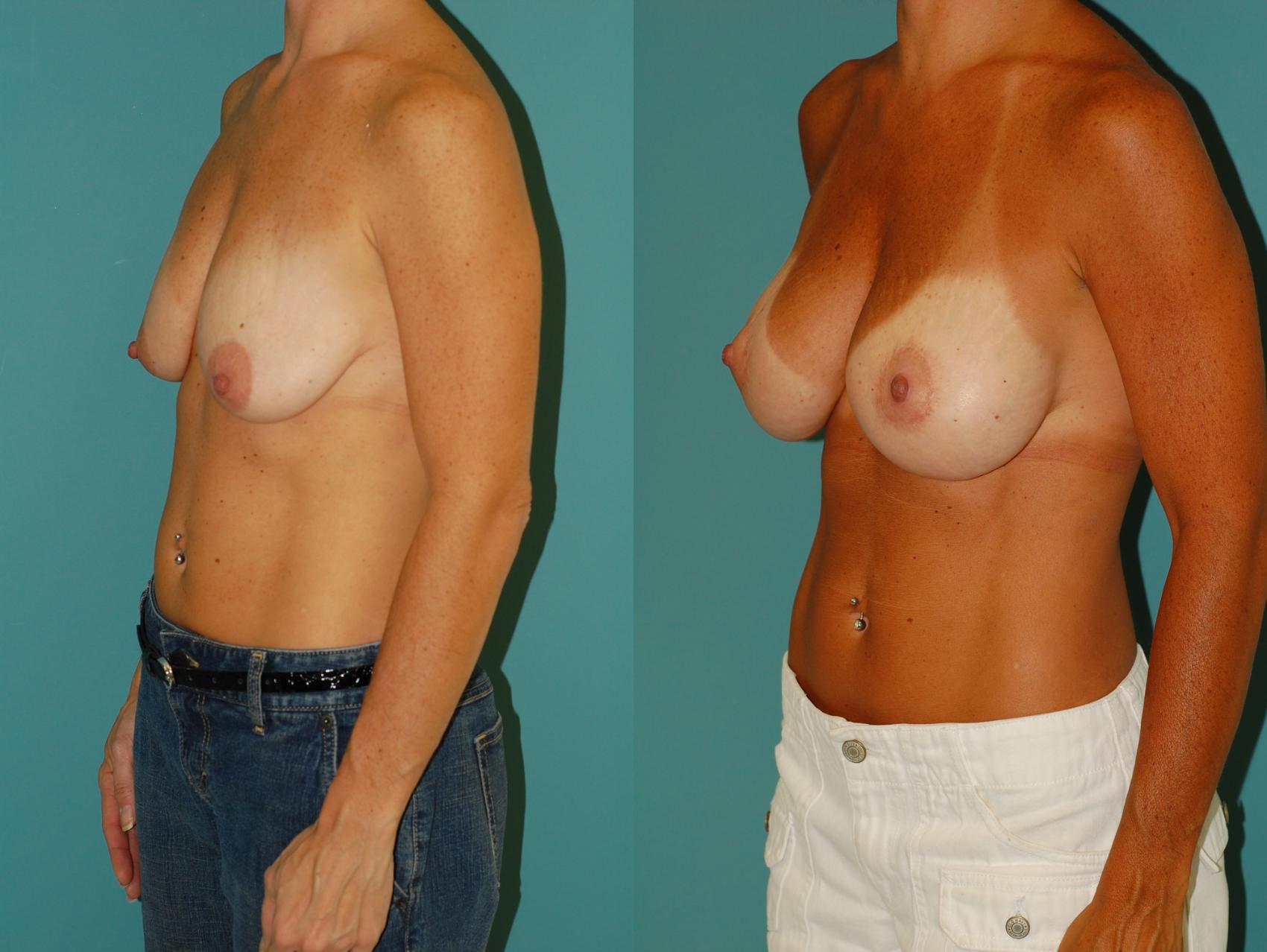 Before & After Peri-Areolar Breast Lift with Implants (Doughnut Mastopexy) Case 24 View #1 View in Ellicott City, MD