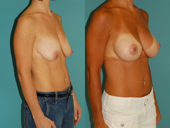 Before & After Peri-Areolar Breast Lift with Implants (Doughnut Mastopexy) Case 24 View #2 View in Ellicott City, MD