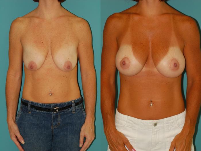 Before & After Peri-Areolar Breast Lift with Implants (Doughnut Mastopexy) Case 24 View #3 View in Ellicott City, MD