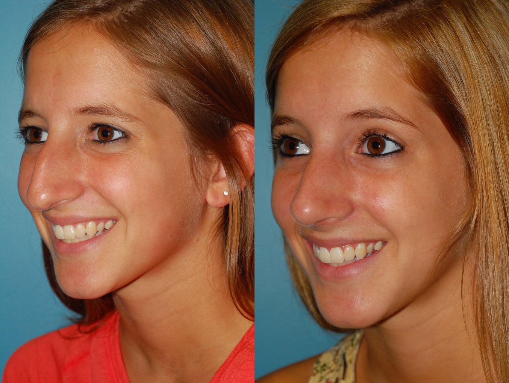 Before & After Rhinoplasty Case 10 View #1 View in Ellicott City, MD