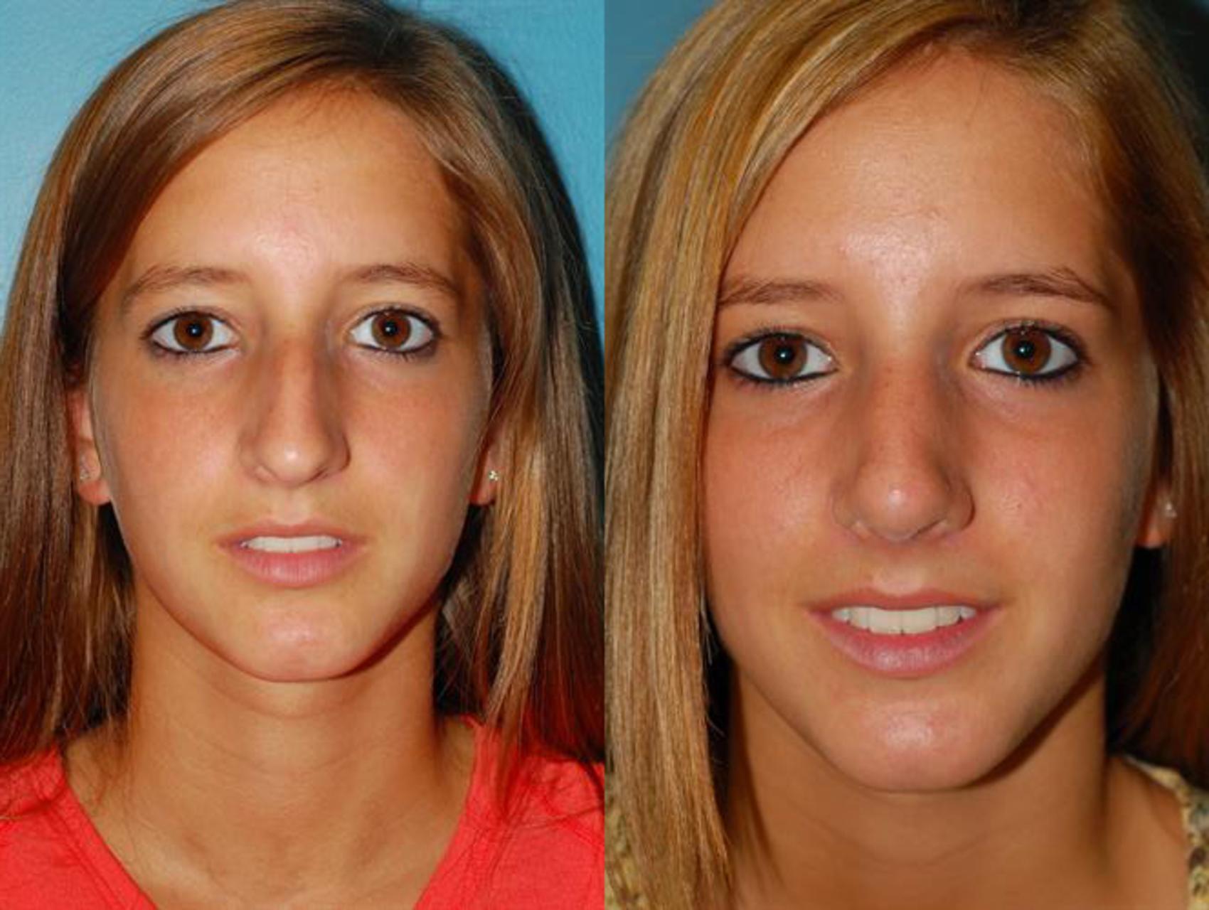 Before & After Rhinoplasty Case 10 View #2 View in Ellicott City, MD