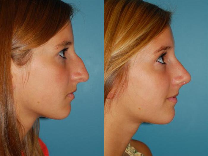 Before & After Rhinoplasty Case 10 View #3 View in Ellicott City, MD