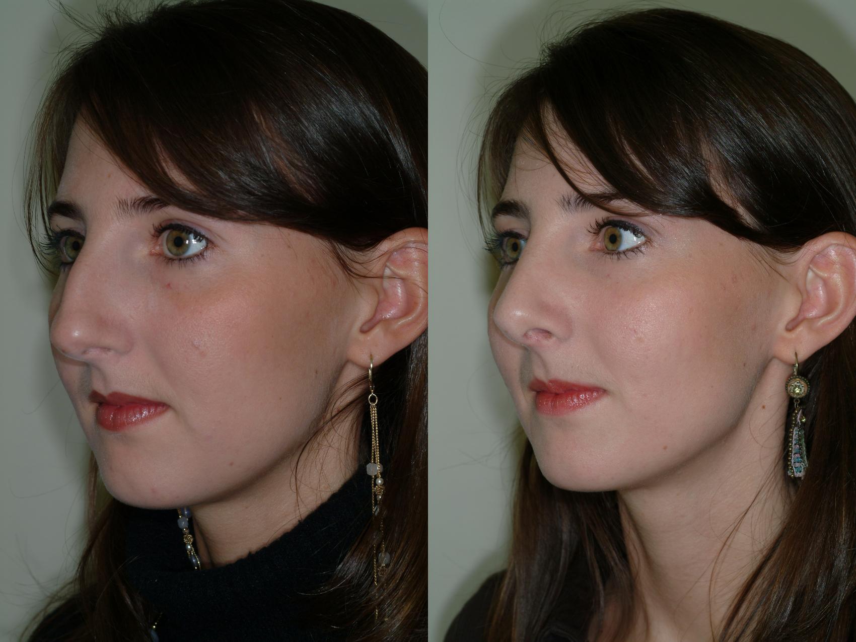 Before & After Rhinoplasty Case 11 View #1 View in Ellicott City, MD