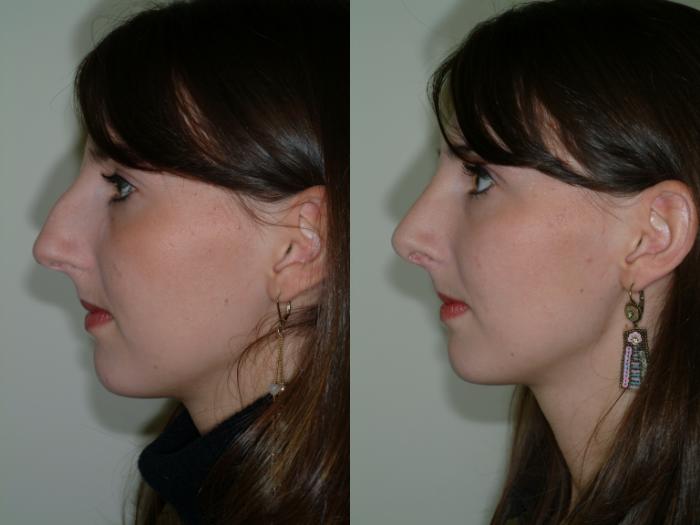 Before & After Rhinoplasty Case 11 View #2 View in Ellicott City, MD