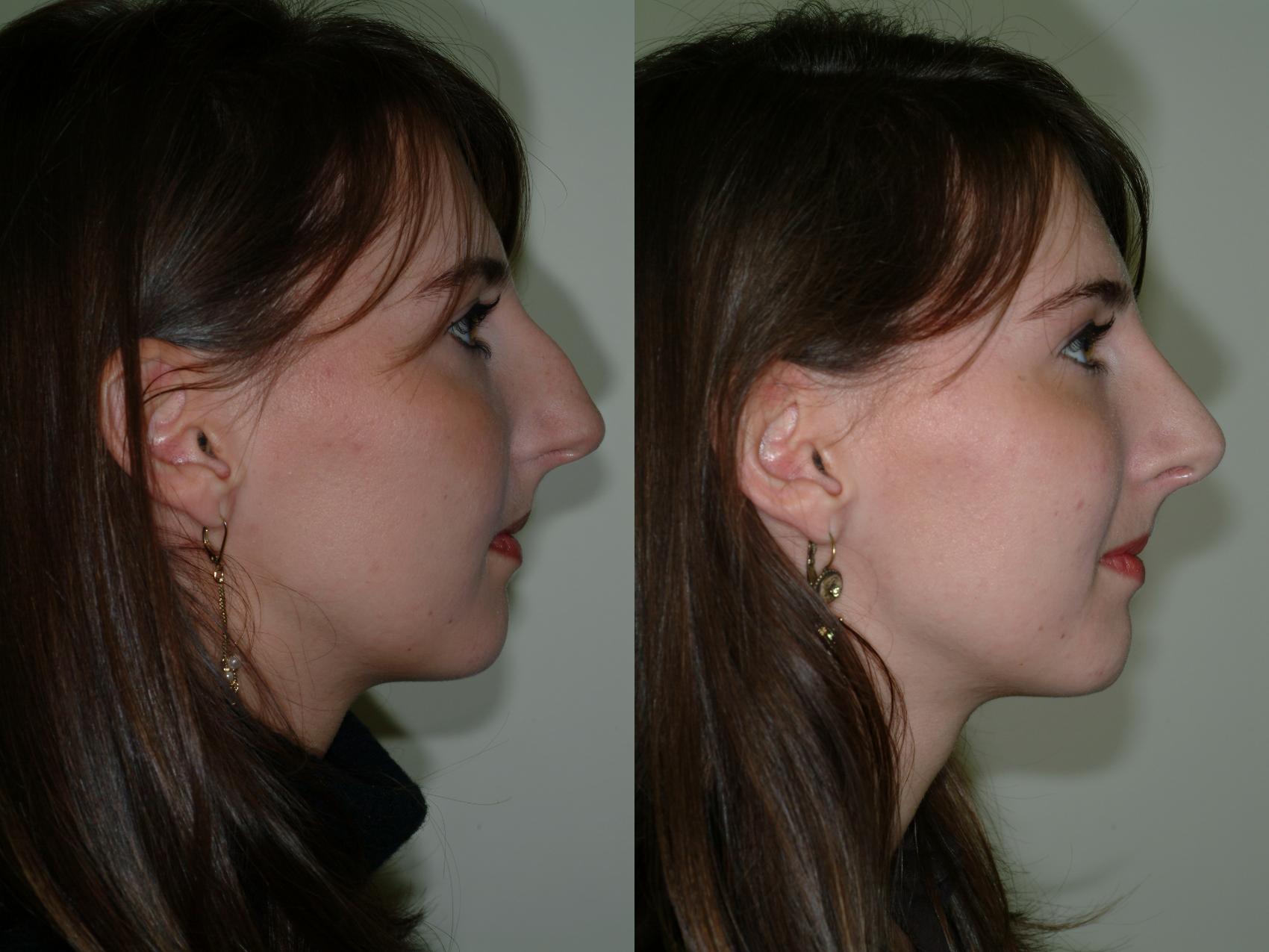 Before & After Rhinoplasty Case 11 View #3 View in Ellicott City, MD