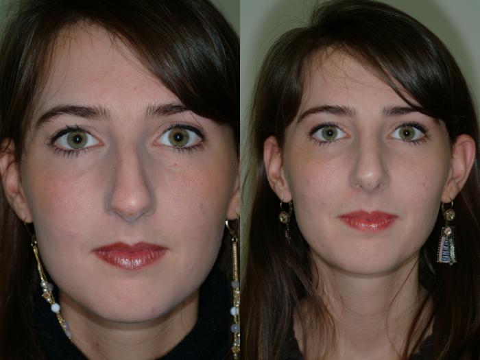 Before & After Rhinoplasty Case 11 View #4 View in Ellicott City, MD