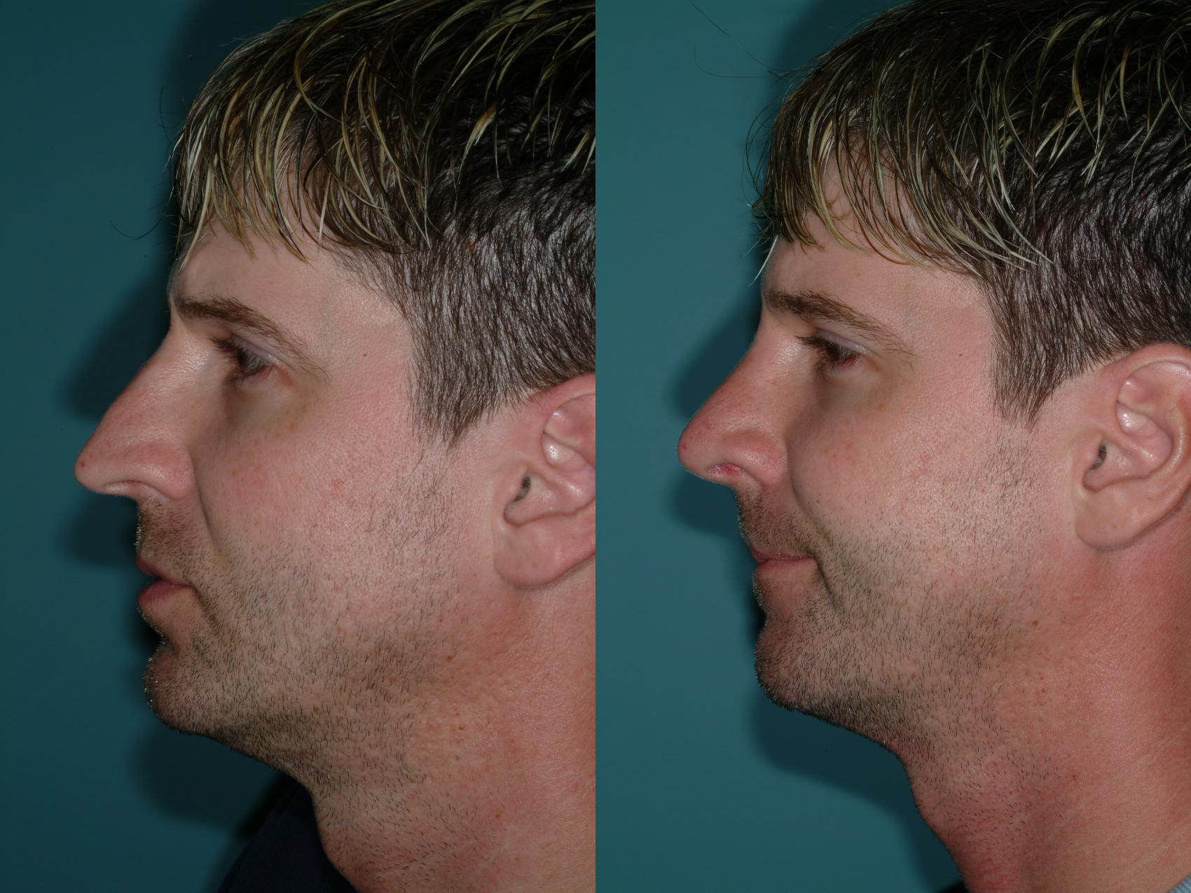 Before & After Rhinoplasty Case 9 View #1 View in Ellicott City, MD