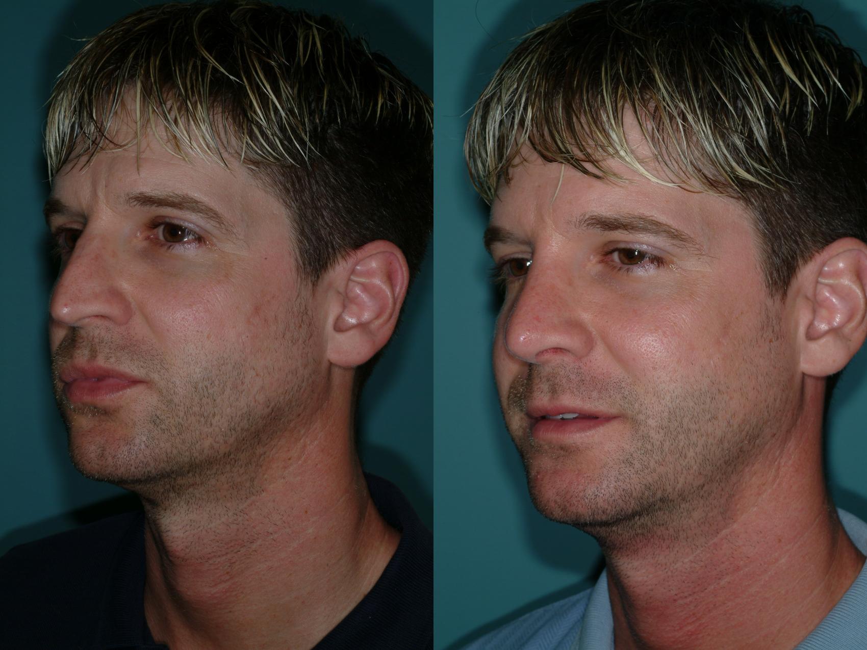 Before & After Rhinoplasty Case 9 View #2 View in Ellicott City, MD