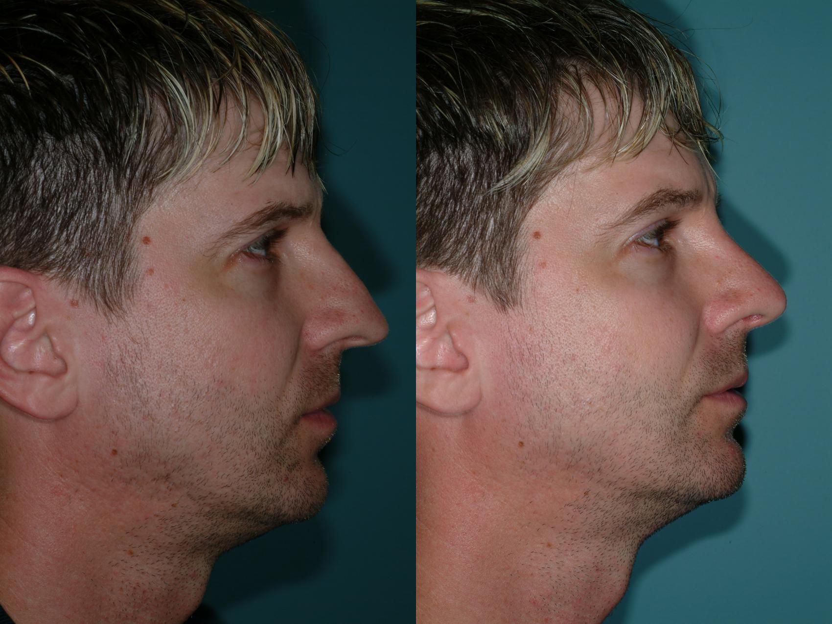 Before & After Rhinoplasty Case 9 View #3 View in Ellicott City, MD