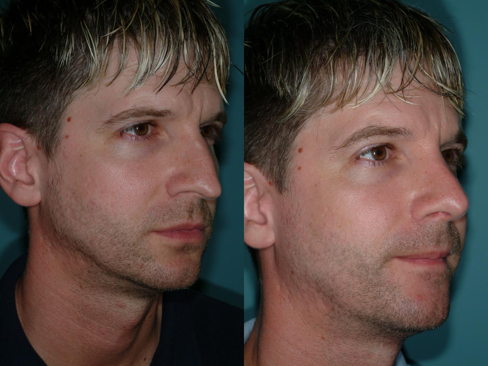 Before & After Rhinoplasty Case 9 View #4 View in Ellicott City, MD