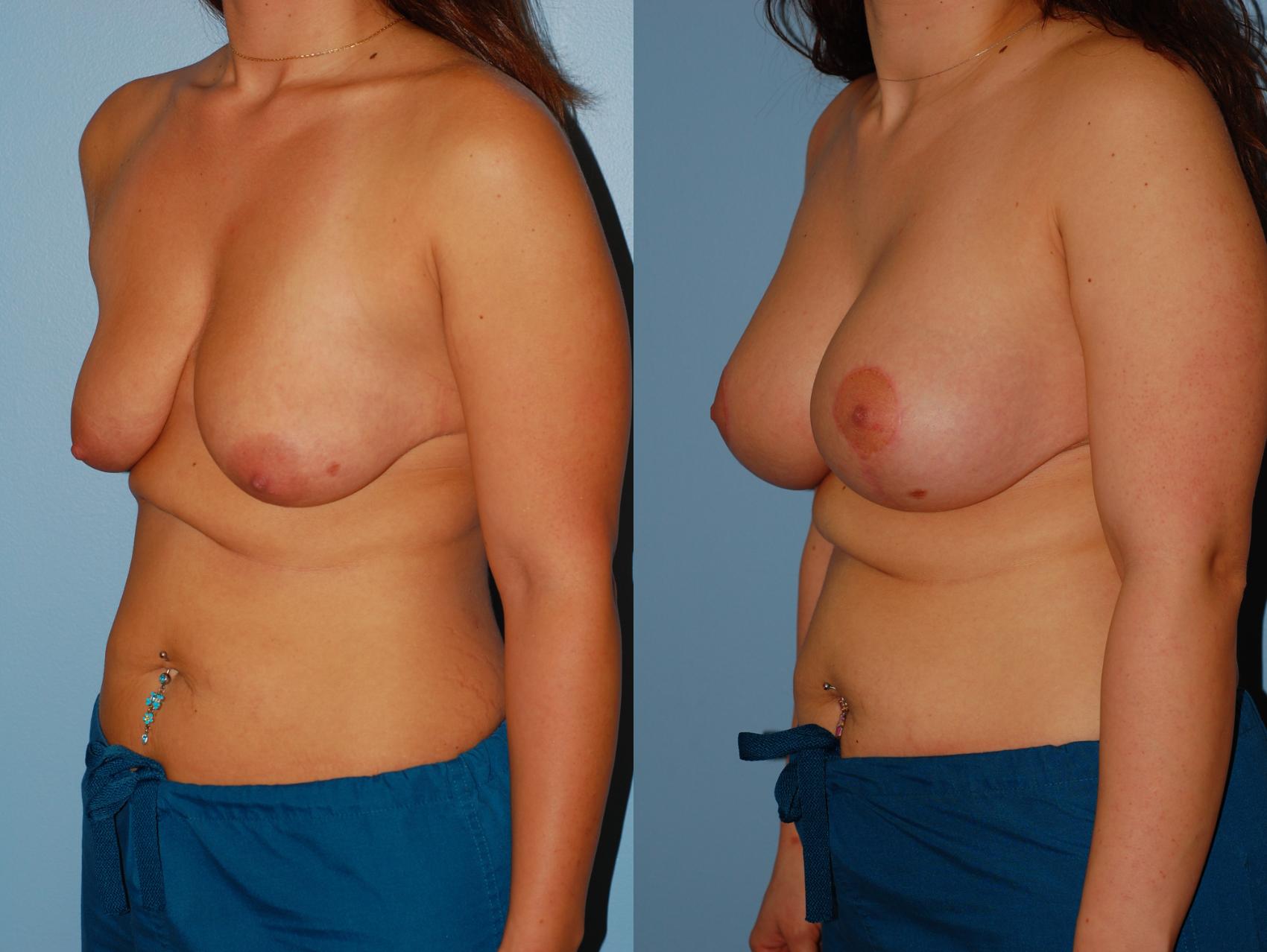 Before & After Standard Breast Lift with Implants Case 25 View #1 View in Ellicott City, MD