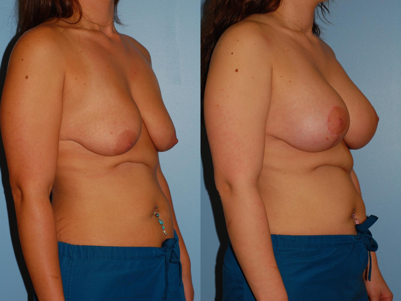 Before & After Standard Breast Lift with Implants Case 25 View #2 View in Ellicott City, MD