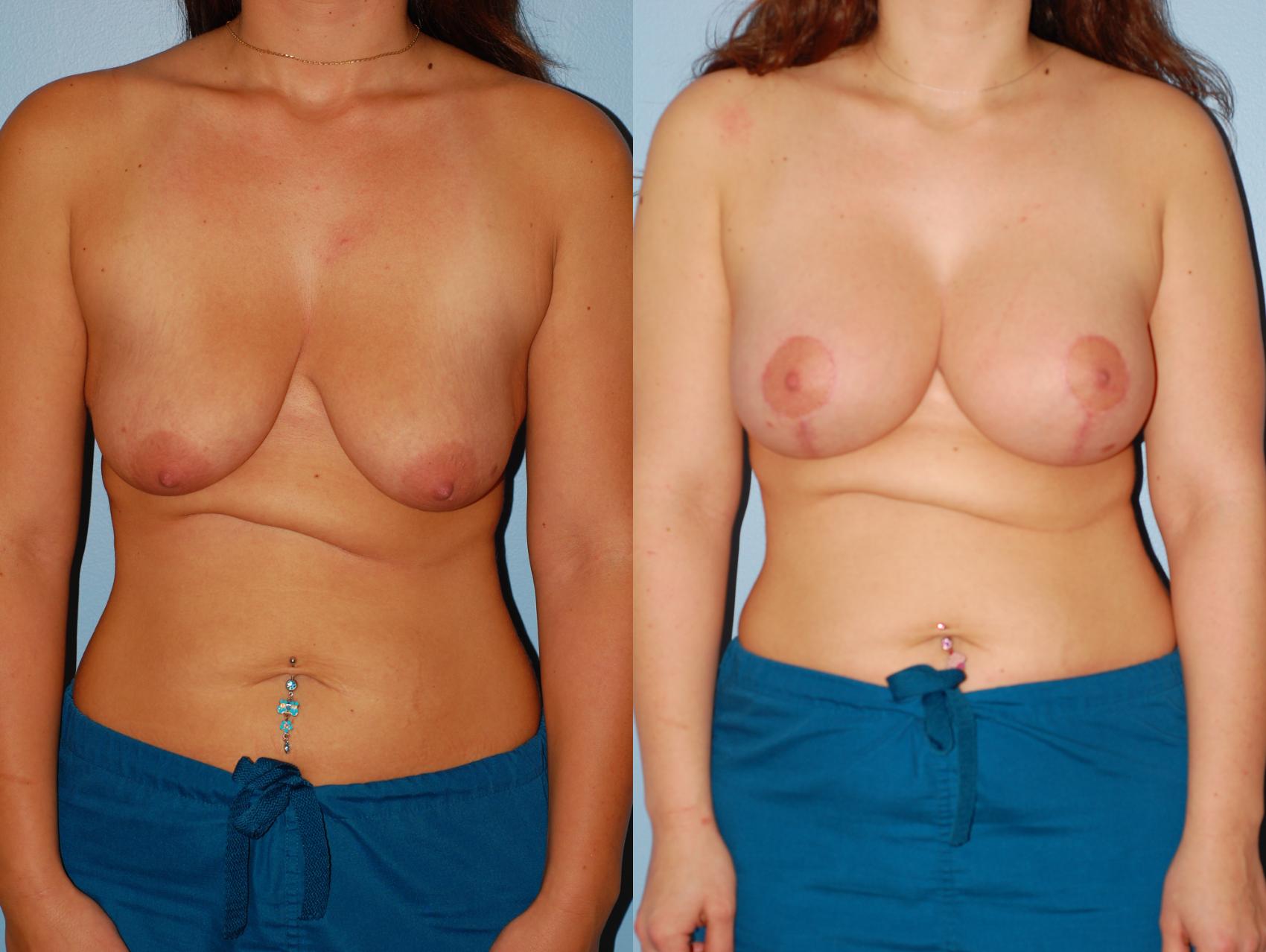 Before & After Standard Breast Lift with Implants Case 25 View #3 View in Ellicott City, MD