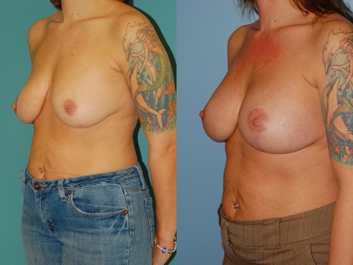 Before & After Standard Breast Lift with Implants Case 26 View #1 View in Ellicott City, MD
