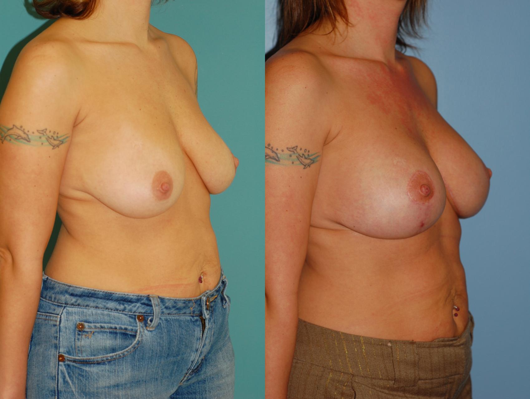 Before & After Standard Breast Lift with Implants Case 26 View #2 View in Ellicott City, MD