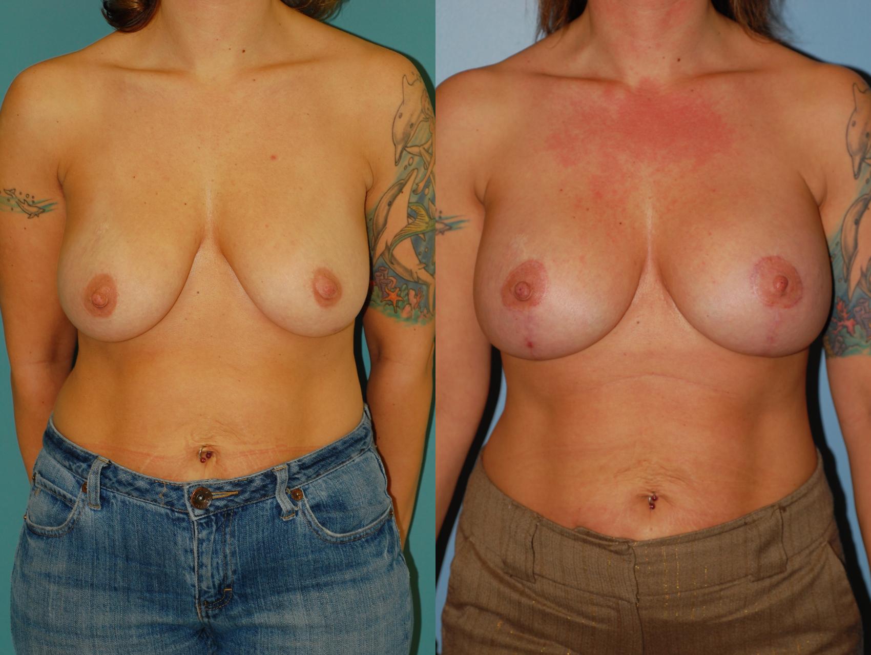 Before & After Standard Breast Lift with Implants Case 26 View #3 View in Ellicott City, MD
