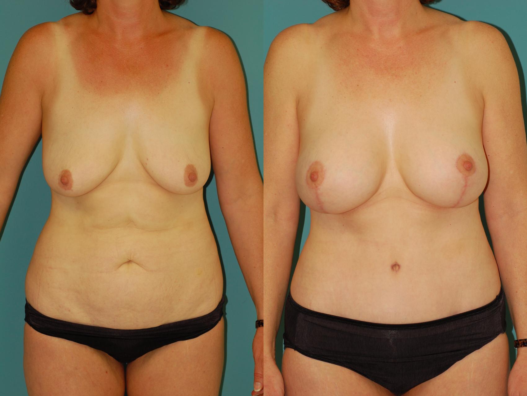 Before & After Standard Breast Lift with Implants Case 27 View #1 View in Ellicott City, MD