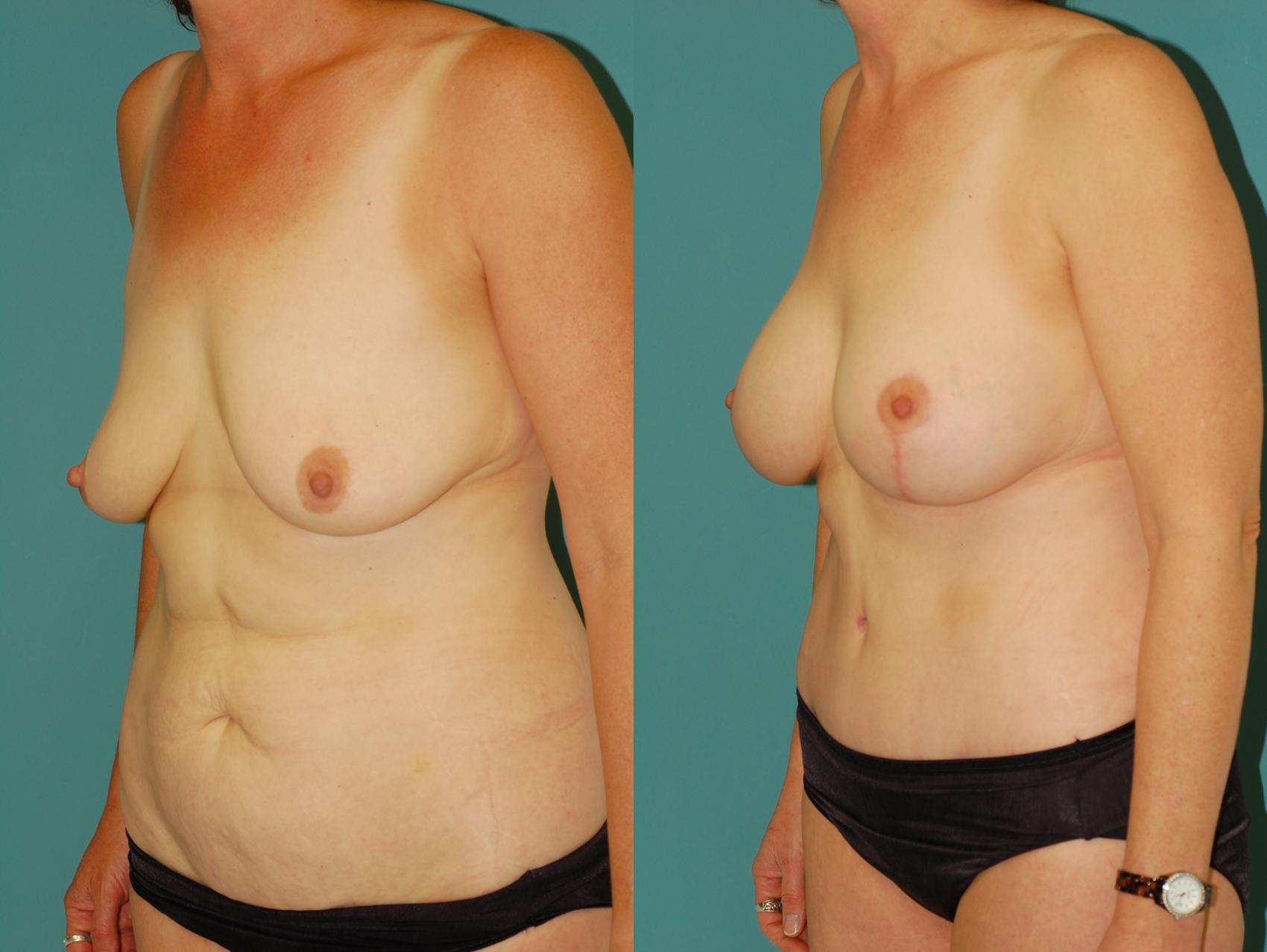 Before & After Standard Breast Lift with Implants Case 27 View #2 View in Ellicott City, MD